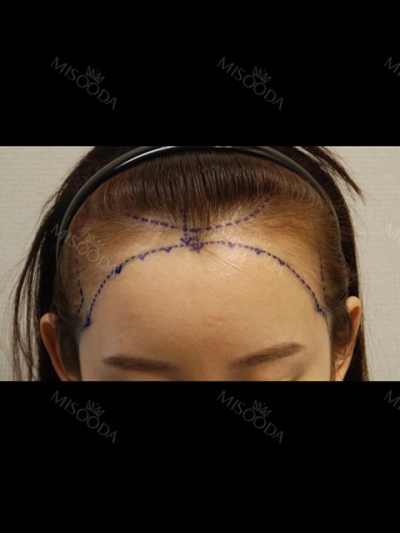 Yonsei Hair transplant Plastic Surgery, Reviews,Images, Promotions — Korea cost, reviews & before-after | MISOODA