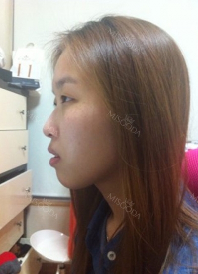 Apgujeongseoul Plastic Surgery,Reviews,Images, Promotion — Korea cost, reviews & before-after | MISOODA