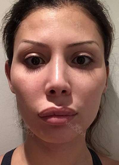 Hyundai Aesthetics, Reviews, Images, Promotions — Korea cost, reviews & before-after | MISOODA