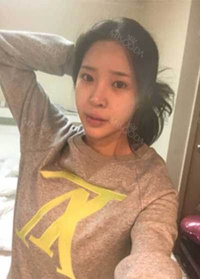 Hyundai Aesthetics, Reviews, Images, Promotions — Korea cost, reviews & before-after | MISOODA