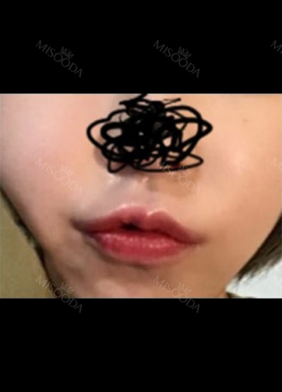 Hyundai Aesthetics, Reviews, Images, Promotions — Korea cost, reviews & before-after | MISOODA