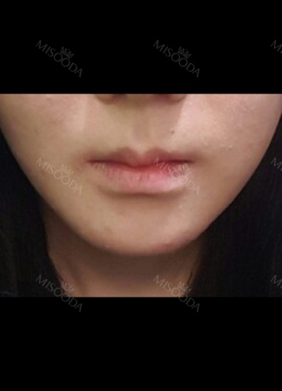 Hyundai Aesthetics, Reviews, Images, Promotions — Korea cost, reviews & before-after | MISOODA