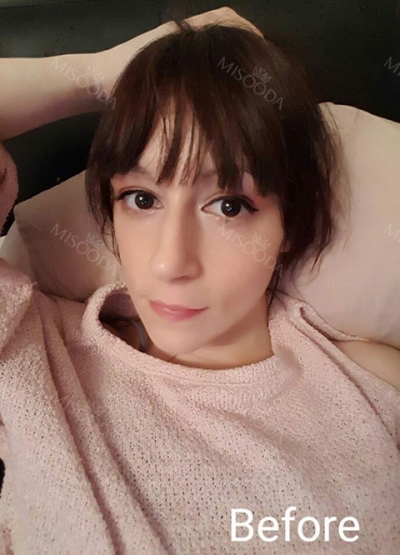 ts plastic surgery — Korea cost, reviews & before-after | MISOODA