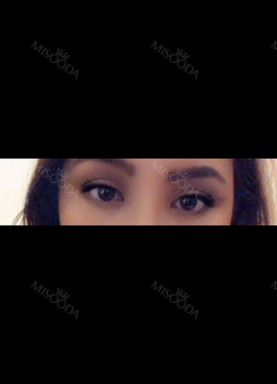 View Plastic Surgery, Reviews, Images, Promotions — Korea cost, reviews & before-after | MISOODA
