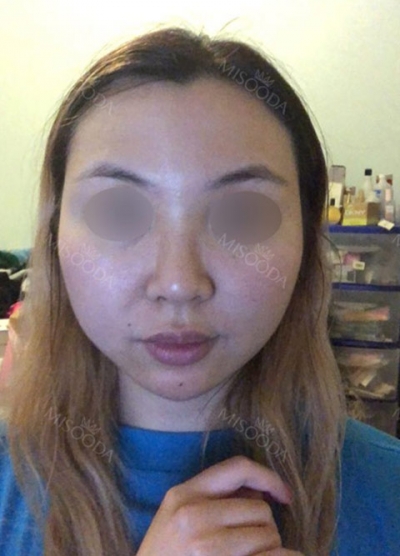 View Plastic Surgery, Reviews, Images, Promotions — Korea cost, reviews & before-after | MISOODA
