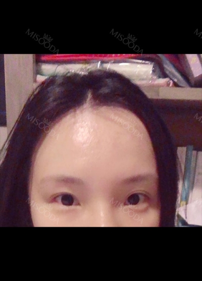 Hyundai Aesthetics, Reviews, Images, Promotions — Korea cost, reviews & before-after | MISOODA
