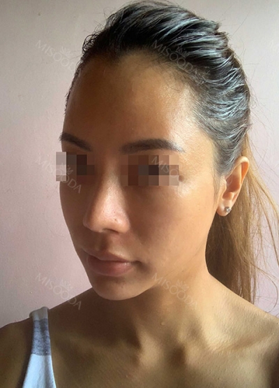 ts plastic surgery — Korea cost, reviews & before-after | MISOODA
