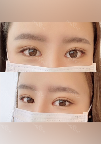 TS Square Jaw Reduction — Korea cost, reviews & before-after | MISOODA