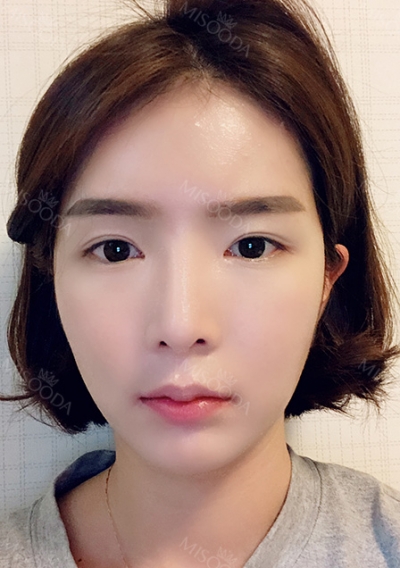 TS Square Jaw Reduction — Korea cost, reviews & before-after | MISOODA