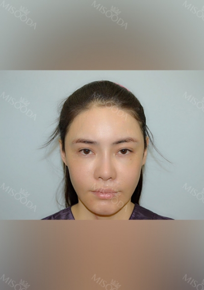 kyunam han, jonglim park, junho choi, banobagi, 345ps, 345plasticsurgery, gangnam plastic surgery, Dr.han, Dr.Park, korea plastic surgery, bone contour surgery, cheekbone surgery, V-line, nose surgery, Asian nose, breast surgery, face lifting, thread — Korea cost, reviews & before-after | MISOODA